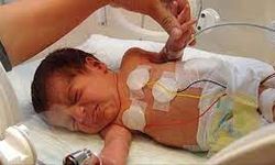 Soluk Borusu Dar Olan Gürcü Bebek, Ameliyatla Nefes Aldı