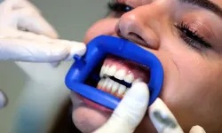 Diş beyazlatma kitleri dişlerinize zarar verebilir !