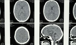 Uykunun REM evresine geçişte zorlanmak Alzheimer belirtisi olabilir