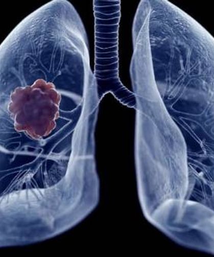 Türkiye akciğer kanserinde dünyada 3. sırada!