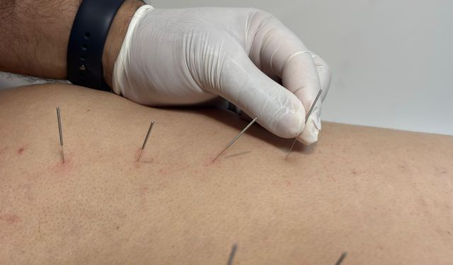 Uşak Eğitim ve Araştırma Hastanesi'nde Çin tıbbının ürünü akupunktur tedavisi başladı