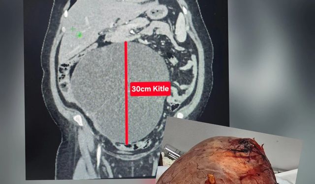 Uşak'ta kabızlık ve şişlik sorunu olan hastanın karnından dev bir kitle çıktı